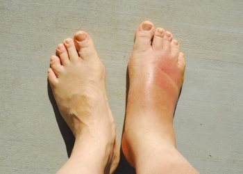 علاج تورم الأقدام