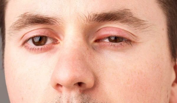 How To Treat Blepharitis Naturally World Today News 