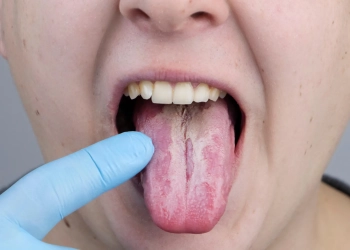 فطريات الفم والأسنان وطرق الحماية من أخطارها على الجسم