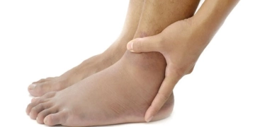 أسباب ظهور التورم في القدمين والساقين
