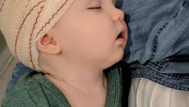 الأولى عالمياً.. جراحة تعالج تشوهاً نادراً بجمجمة رضيع